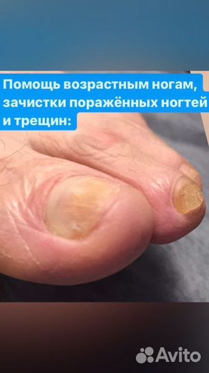 Подолог, вросший ногототь, зачистка грибка, трещин