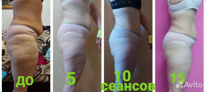 LPG массаж канавино