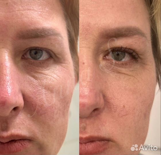 Холодная плазма, подтяжка лица, шеи и век