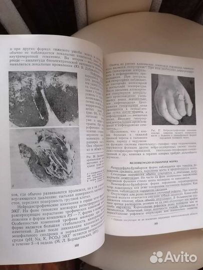 Тяжелая закрытая травма черепа и головного мозга