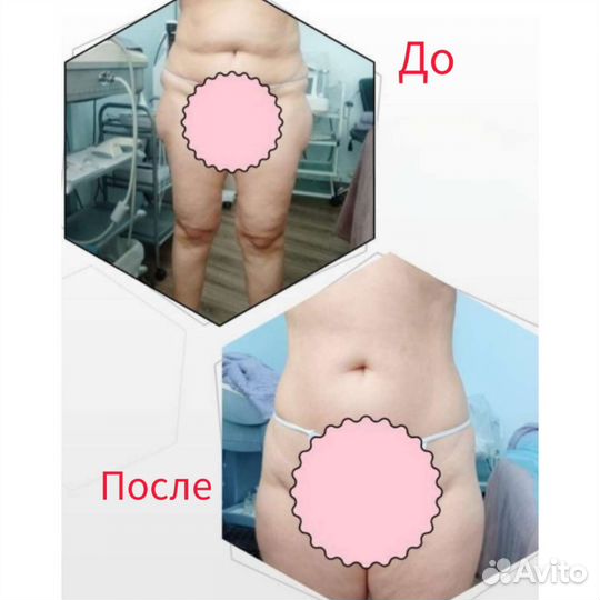 Антицеллюлитный массаж