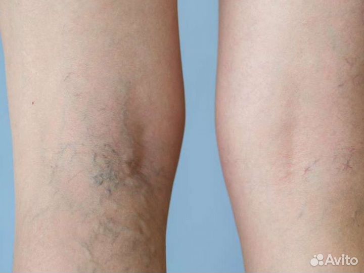 Удаление сосудов (сосудистой сетки)