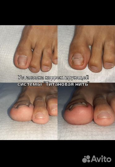 Подолог, аппаратный педикюр