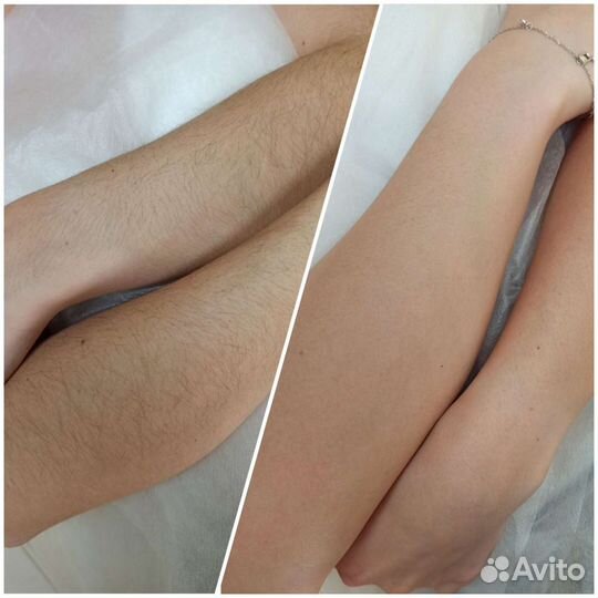 Шугаринг и ваксинг