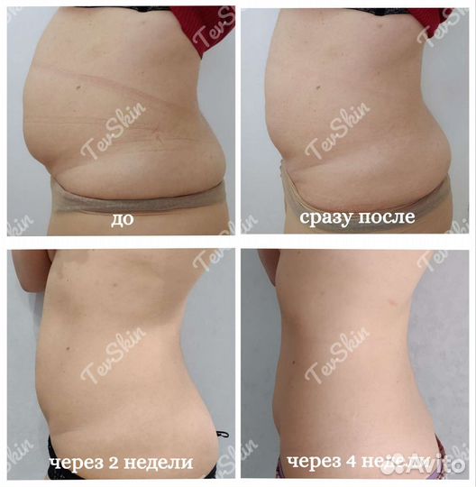 Липосоникс.Коррекция фигуры.Уменьшение объемов