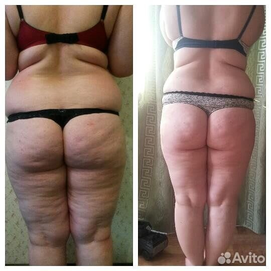 Антицеллюлитный массаж выезд на дом