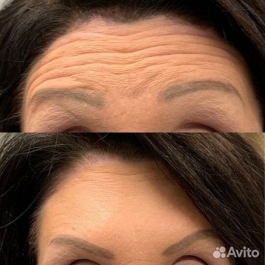 Ботокс, коктейль монако