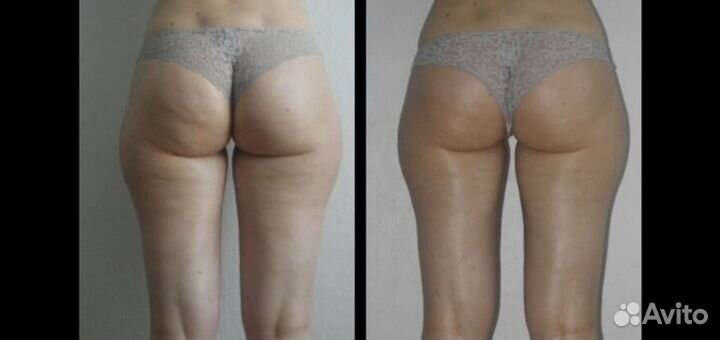 Антицеллюлитный,лимфодренажный,Кудрово Областная