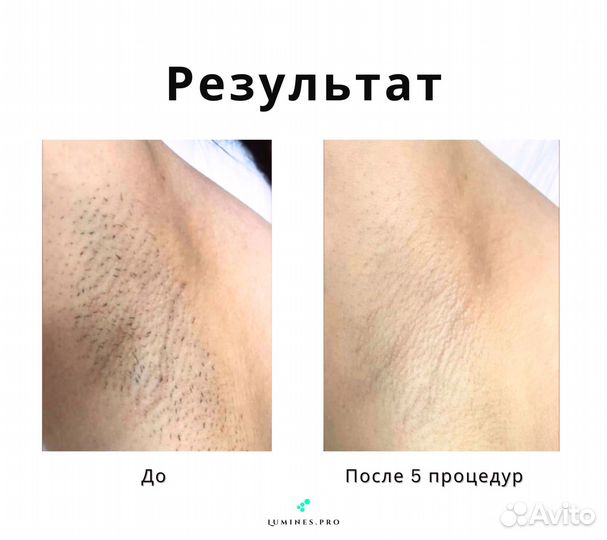 Диодный лазер для эпиляции Люминес’ Макс-Ван 1200 Вт