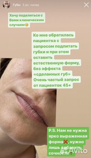 Увеличение губ