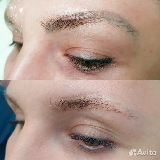 Удаление татуажа ремувером