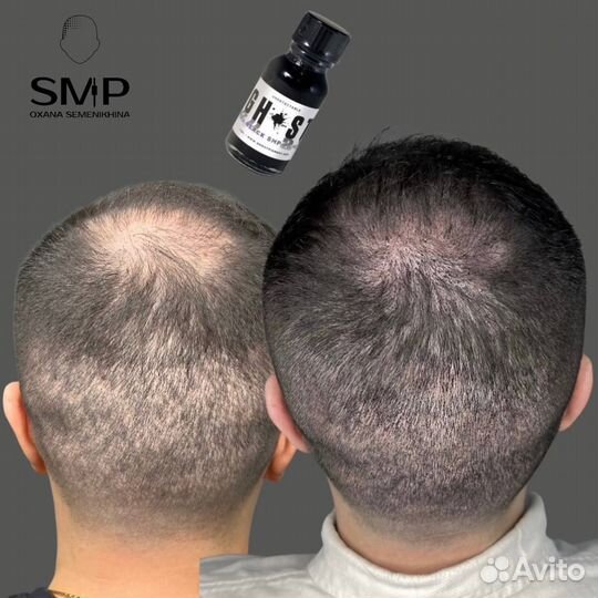 Трихопигментация SMP