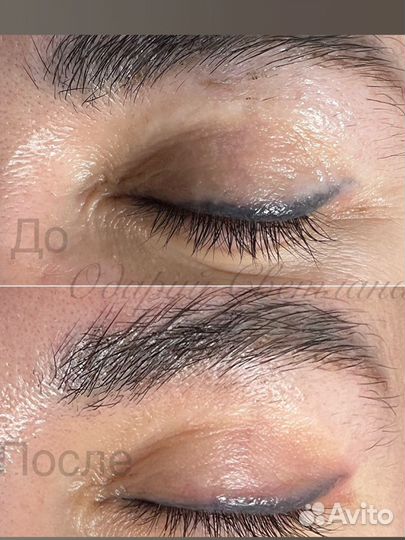 Удаление татуажа ремувером