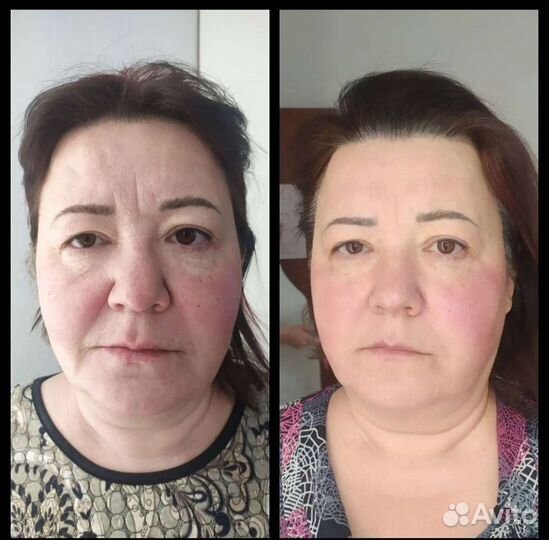 Скульптурно-буккальный массаж лица,рф,чистка лица