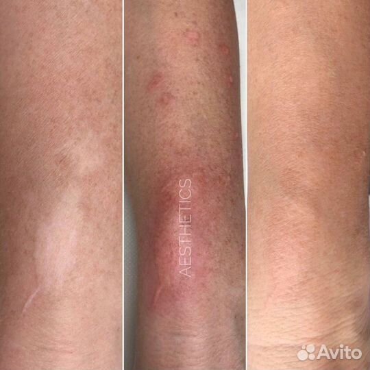 Реконструктивная дермопигментация