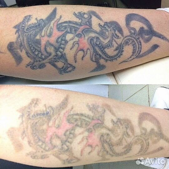 Удаление татуировок