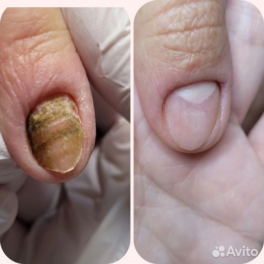 Травма ногтя. Подолог СПб