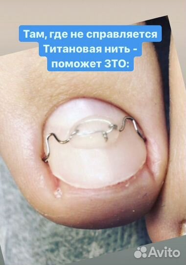 Подолог, вросший ногототь, зачистка грибка, трещин