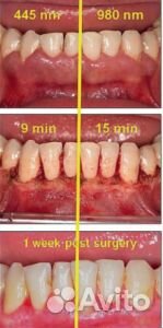 Стоматологический лазер Cheese DEN 10C