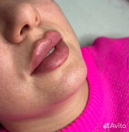 Увеличение губ