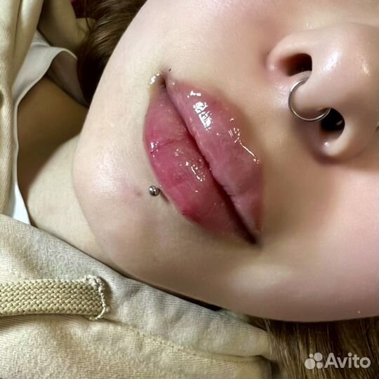 Увеличение губ косметолог