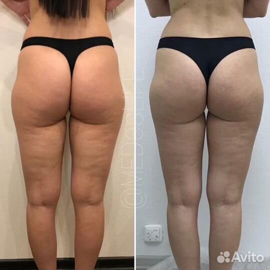 Эндосфера, похудение за 1 сеанс