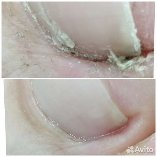 Аппаратный, Медицинский педикюр (Подолог)