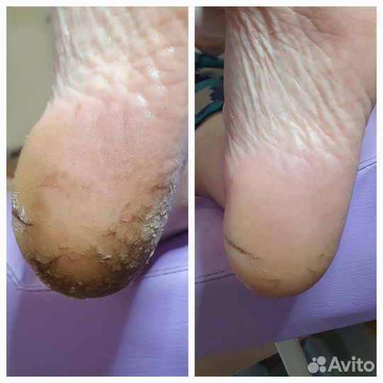 Лечение вросших ногтей