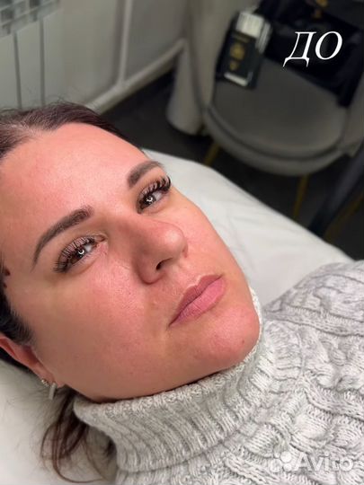 Контурная пластика губ