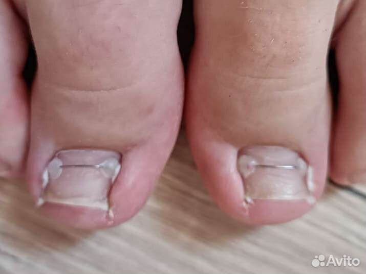 Установка титановой нити