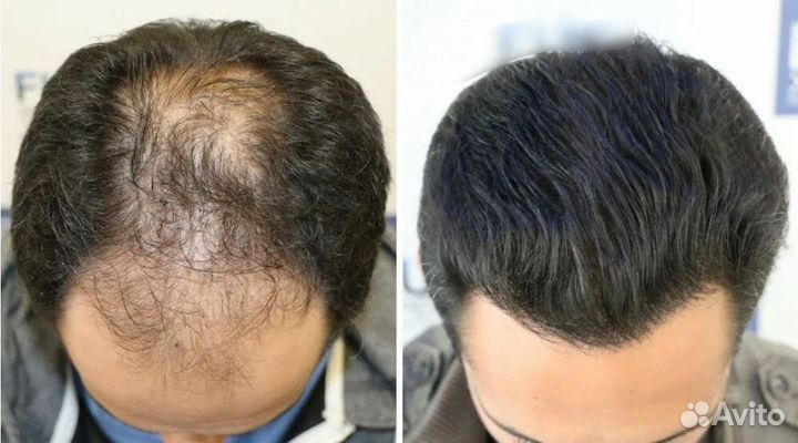 Пересадка волос с пожизненной гарантией
