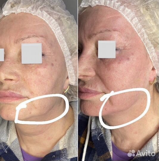 Мезонити,подтяжка лица