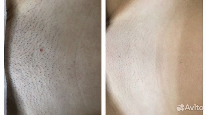 Эпиляция elos