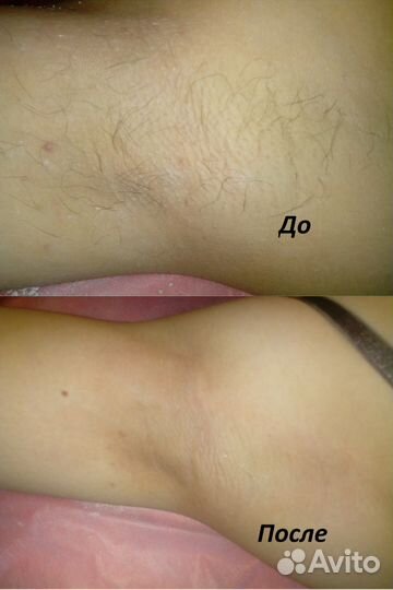 Шугаринг, ваксинг (воск) Уралмаш