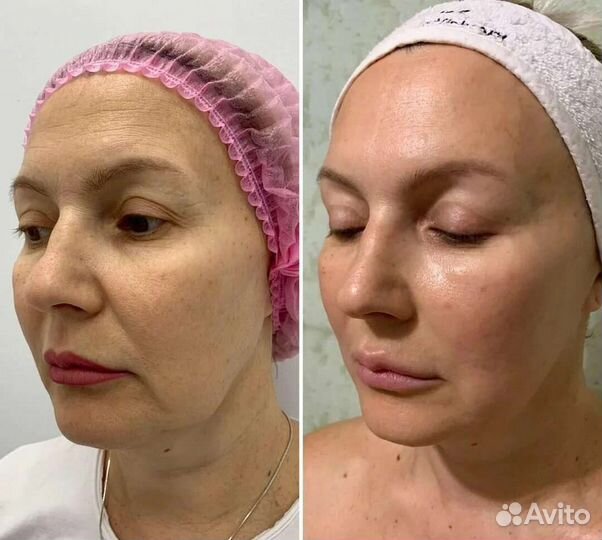Аппаратное Омоложение лица