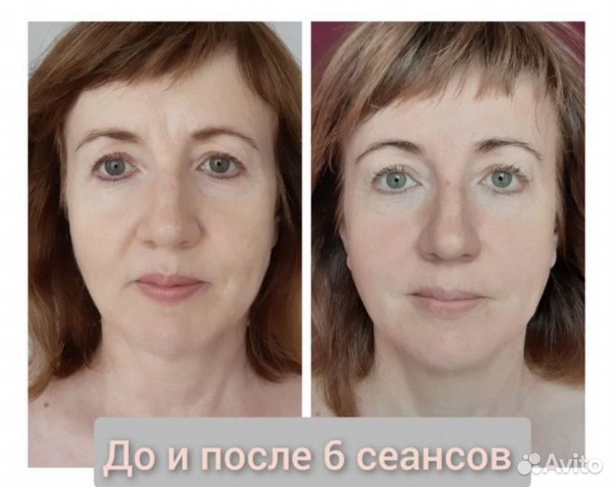 Мадеротерапия Лица