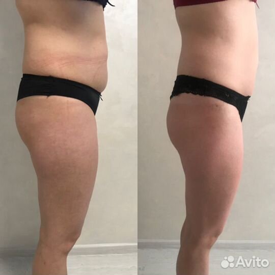 Антицеллюлитный массаж