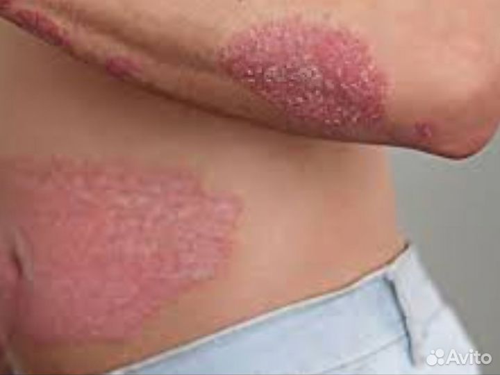 От псориаза