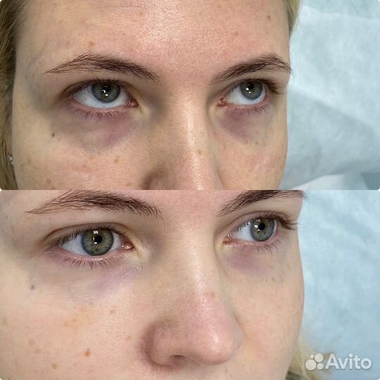 Ботокс/ Ботулинотерапия