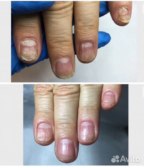 Подолог: Вросший ноготь. Мозоли. Трещины. Грибок