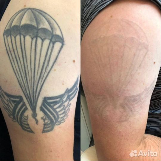 Удаление тату Лучший Лазер в Иваново