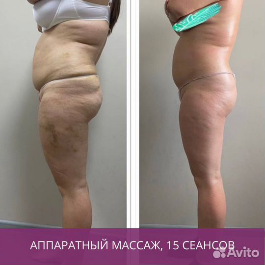 Массаж (все виды), LPG массаж, коррекция фигуры