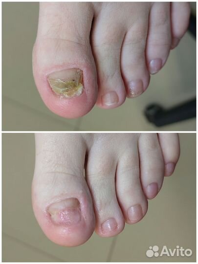 Медицинский педикюр. Подология