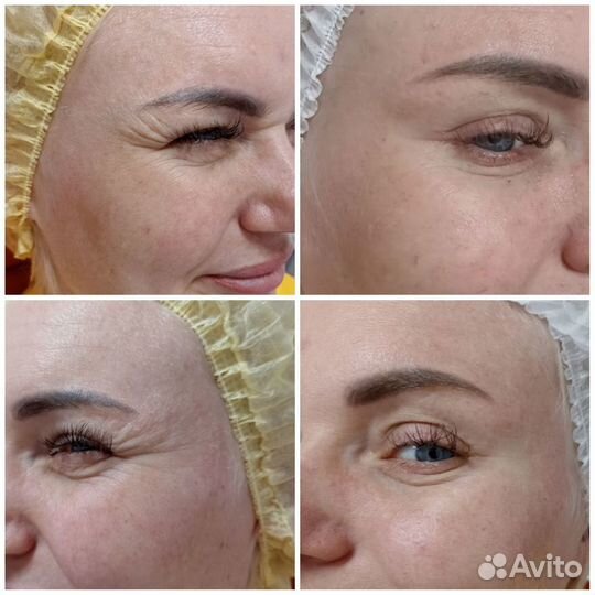 Модель на ботокс лица Full Face Монако