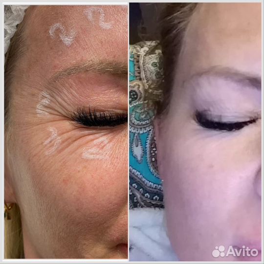 Ботокс.Устранение морщин