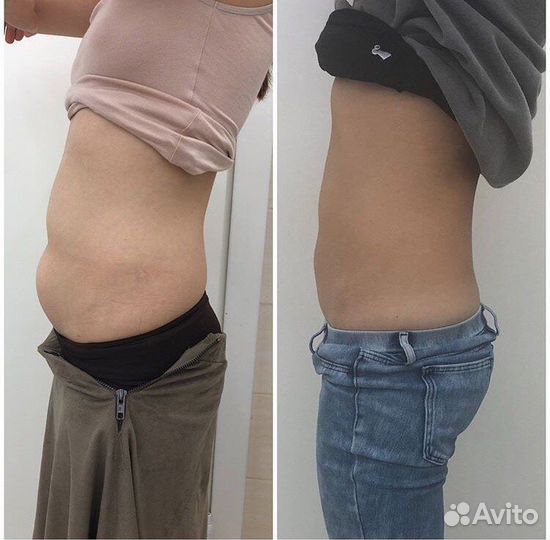 Плазмолифтинг, прессотерапия