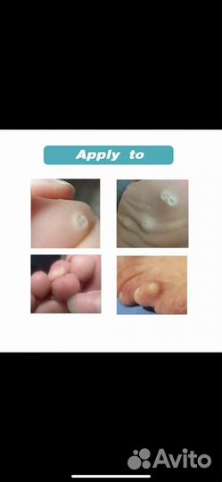 Пластырь от стержневых мозолей