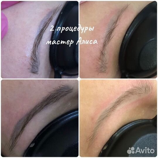 Лазерное удаление татуажа и тату