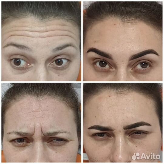 Модель на ботокс лица Full Face Монако