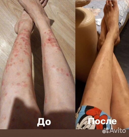 Средство от псориаза